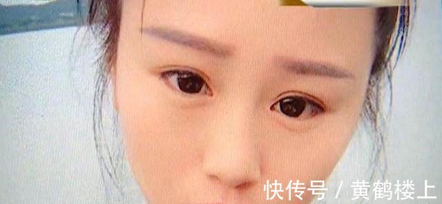 三角眼|美女为漂亮整容,一年后鼻子歪了,眼睛也成了三角眼!商家碰瓷!
