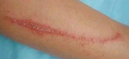 红包|宝宝身上有“红包”，就是被蚊子咬的？这种虫子更要小心