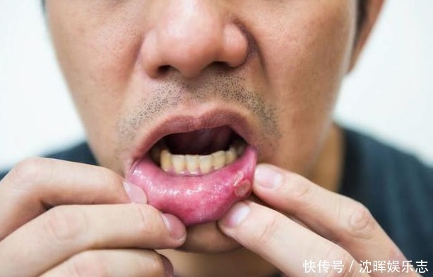 西瓜霜|口腔溃疡虽是小小一个，但却疼痛难忍，一类野草一抹，第二天就好