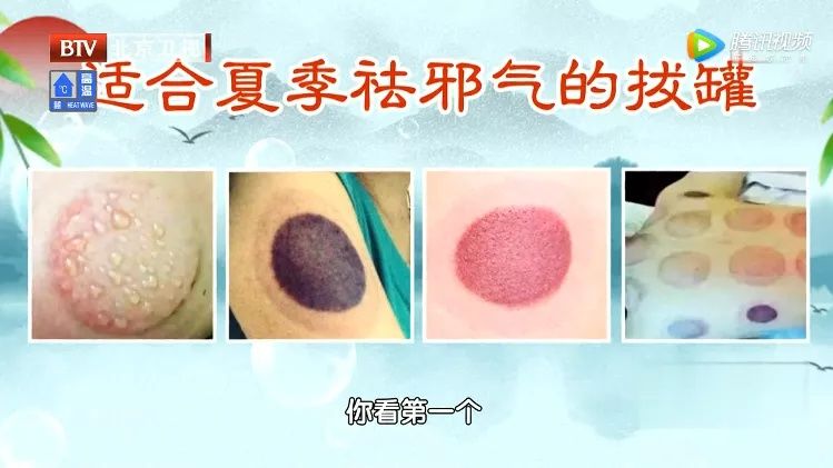 身体这处有凹陷，暗示脾虚了！一个穴位，帮你健脾和胃，补中益气~