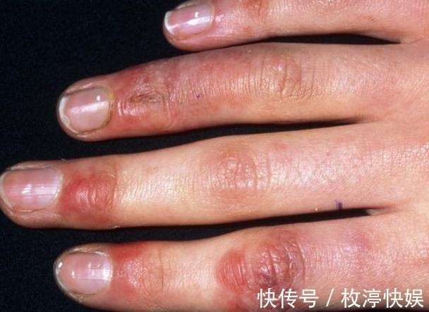 天冷了，有冻疮怎么办一味中药，水煎，浸洗，很方便