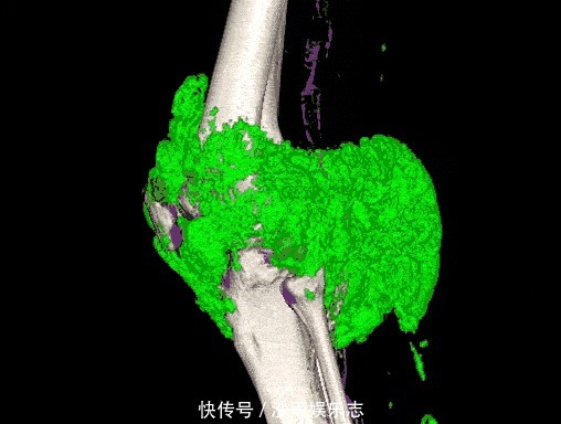 苏打水|痛风患者,喝柠檬水、苏打水能把尿酸降正常吗医生告诉您