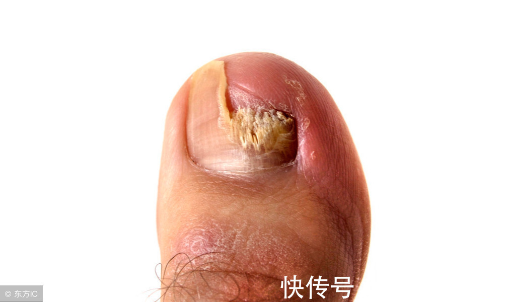 甲周|16岁少女6年没剪过趾甲，这酸爽，简直不忍直视，青少年应注意