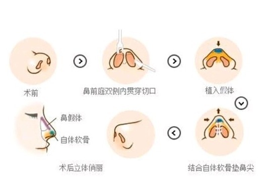 鼻翼肥大 双侧耳软骨隆鼻可以维持多久?术后可以永久保持吗?