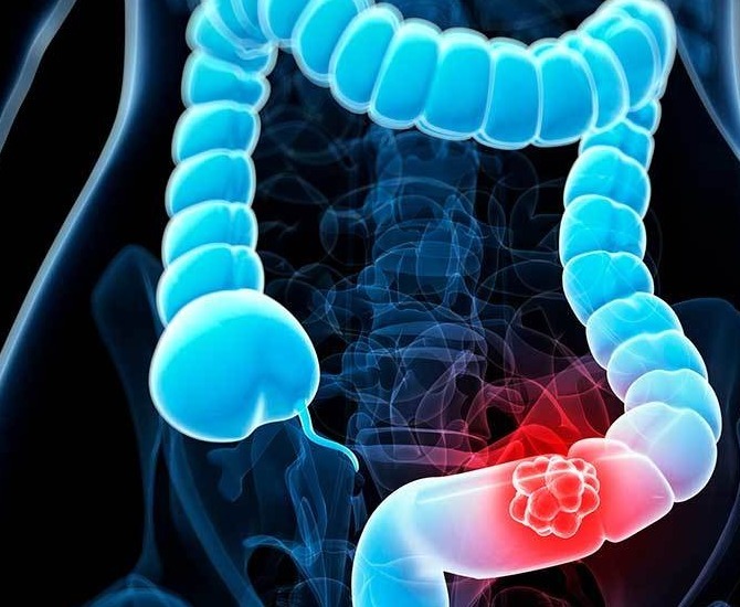 假性腹泻|肠癌早期不明显提醒这4种“迹象”或是肠癌的前兆，留心一点