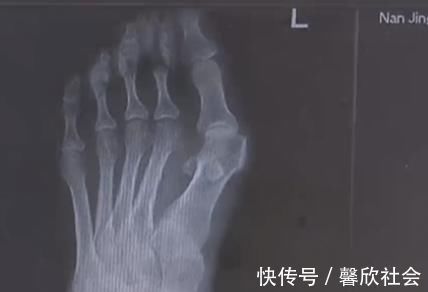 女性 爱穿高跟鞋的女性一定要小心,拇指外翻堪比“裹脚”!不可忽视