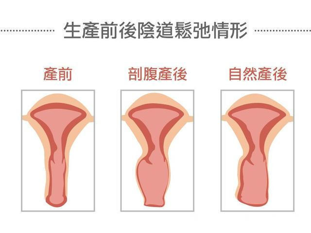 弹性|越来越多顺产女人被老公嫌弃过来人说出隐情,嫌弃不只是顺产
