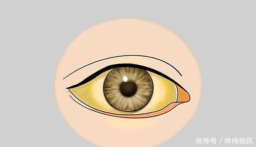 医生|肝癌不会突然发生!医生:身体会给3次机会,若不抓住,后悔莫及