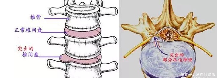 颈椎|枕头不适合也会导致颈椎病！教你如何挑选合适的枕头来保护颈椎！