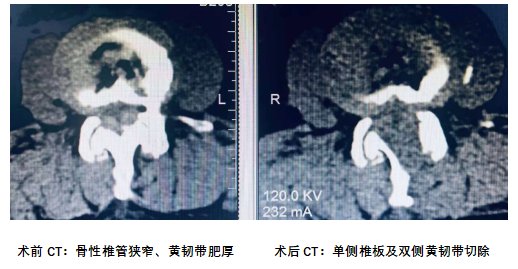 李奶奶|多年走路双腿像灌铅,济南市中心医院小切口解决腰椎管狭窄