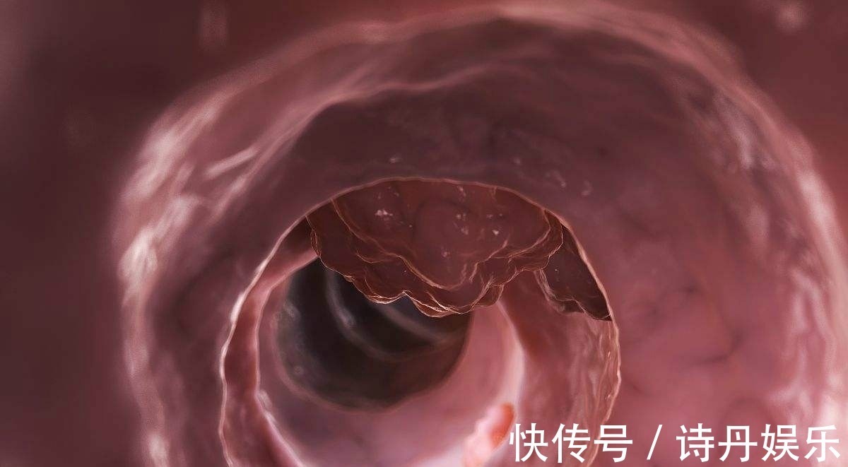 警报|大肠癌早期,身体会发出三个警报,40岁以上的人切莫忽视