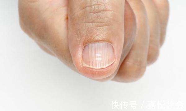 预防癌症|“写在”手上的3个癌症“现象” 提早发现 预防癌症“找上门”