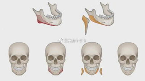 松弛 下颌角手术会导致皮肤松弛吗？松弛了还能改善吗？