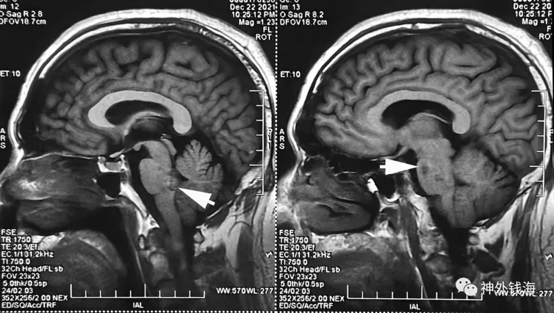 海绵状血管瘤|一例脑干海绵状血管瘤的手术陷阱
