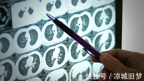 治疗|结节性硬化对生活有哪些影响，可以治疗吗？