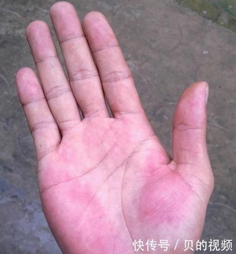 肝脏好不好,都“写”在手上了,手上若无3种“异常”,肝还不错