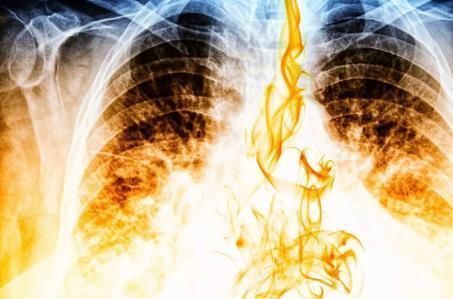 日常生活中|为什么越来越多的人会患上肺癌 听听医生是怎么说的!