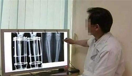 李亚诺|高三学生因身高矮小自卑，花16万断骨增高7.2厘米，如今怎样？