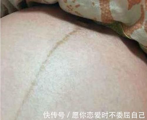 肚子|孕妈肚子上的黑线是什么?线在左是男在右是女?原来这么多讲究!