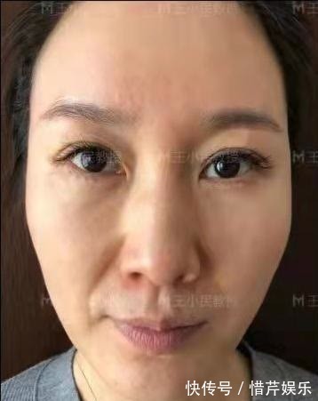 小拉皮 拉皮除皱王小民教授:46岁的她选择了小拉皮手术,看看效果反馈!