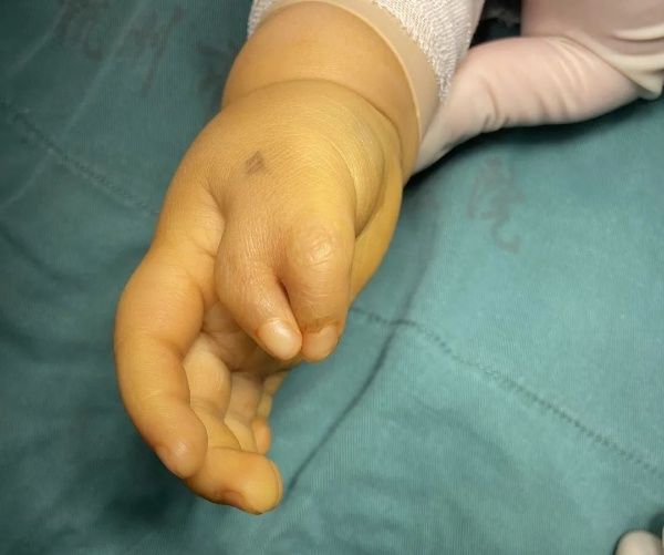 整形外科|2岁男孩长了一对“蟹钳”！医生提醒：切勿错过最佳手术时机