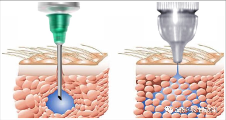 针头|疤痕的激素注射治疗