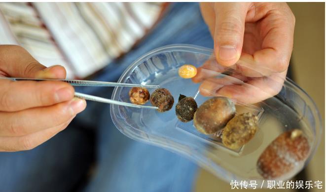 前列腺囊肿是怎么回事?出现这4大“症状”,要警惕