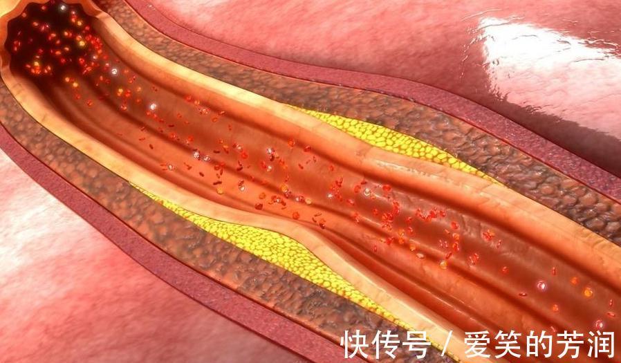 脑卒中|颈动脉斑块是否能逆转?医生道出4个注意事项,不妨收藏下!