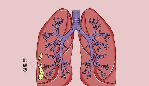  肺部|做肺部CT时，发现阴影是不是肺内有癌了？医生：还有3个可能