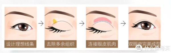 13年前做的双眼皮到现在还好吗?双眼皮带给我的变化