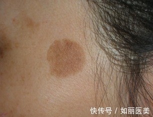 色斑 各类色斑问题如何对症下药,医美祛斑干货!