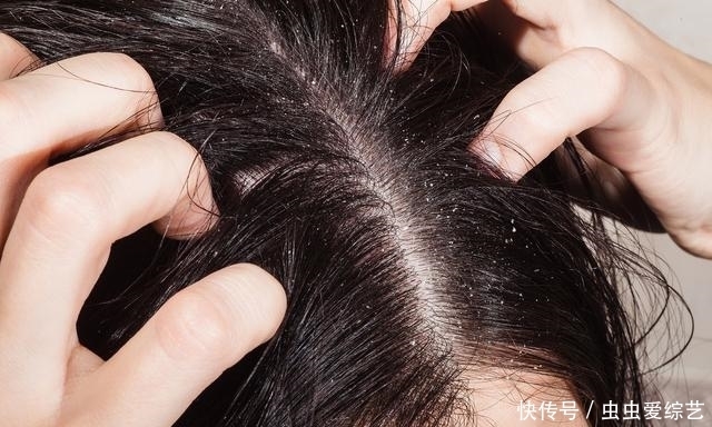 天呐!螨虫居然能在头上搞出那么多事,你是不是也中招了?