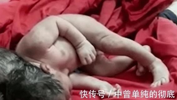 手术切除|奇闻：印度女子产下三头婴儿！怀孕期间并无异常，医生：外星人