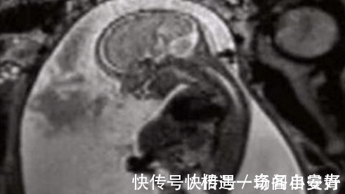 肚子|孕妇做产检却被告知肚中有肿瘤, 医生建议立刻动手术, 数月后孩子出生众人傻了眼