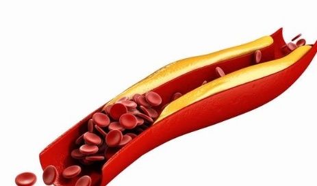 血脂|高血脂能不吃药吗？饮食如何控制？本文为你讲出正确答案