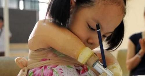 何总|孕妇28周被告知是“海豚胎”,家人不放弃,10年后却如此优秀