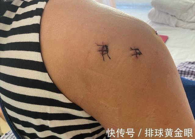 右肩|颜妮右肩植入8枚钢钉，还将进行右膝修复，朱婷手术时间牵动人心