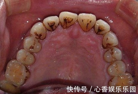 小苏打|“牙结石”用手抠无用功，专家教你1招，脏东西不久“哗哗”掉！