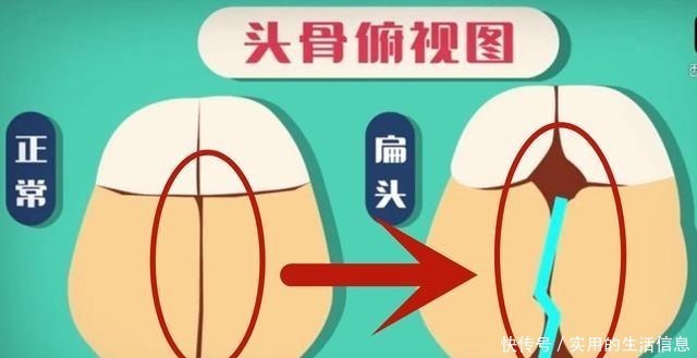 小碰|“妈妈别给我睡扁头”，为何老一辈坚持给娃睡扁头，真的很毁颜值！