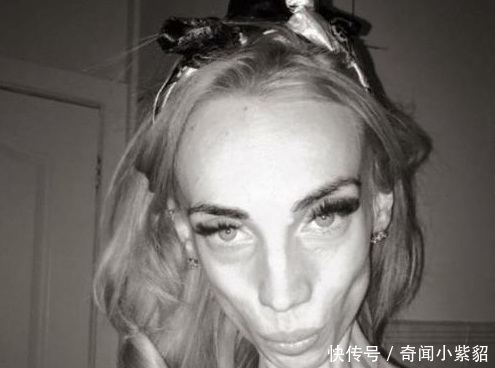 女子|女子患病瘦到25公斤,走在街上,人人躲她,增肥后惊艳大家