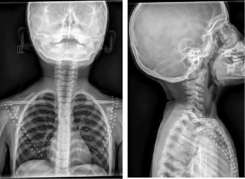 椎体|脊柱常见肿瘤及肿瘤样病变的几种影像学表现,你都见过吗?