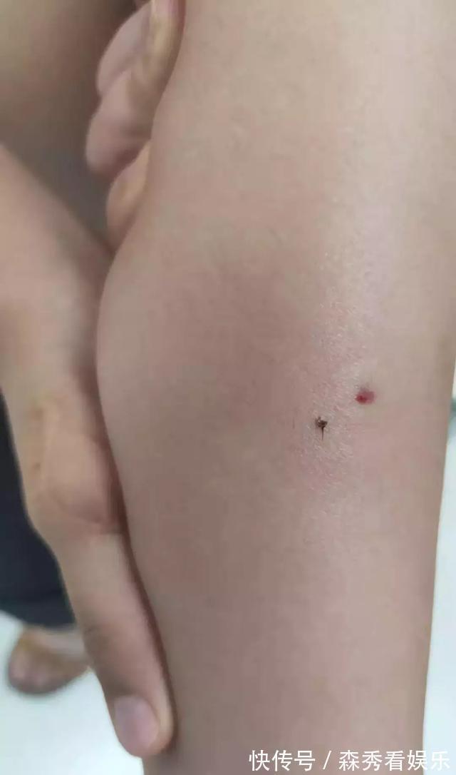 丧命|3岁女孩因为一根刺险丧命!妈妈的这个做法救了孩子!