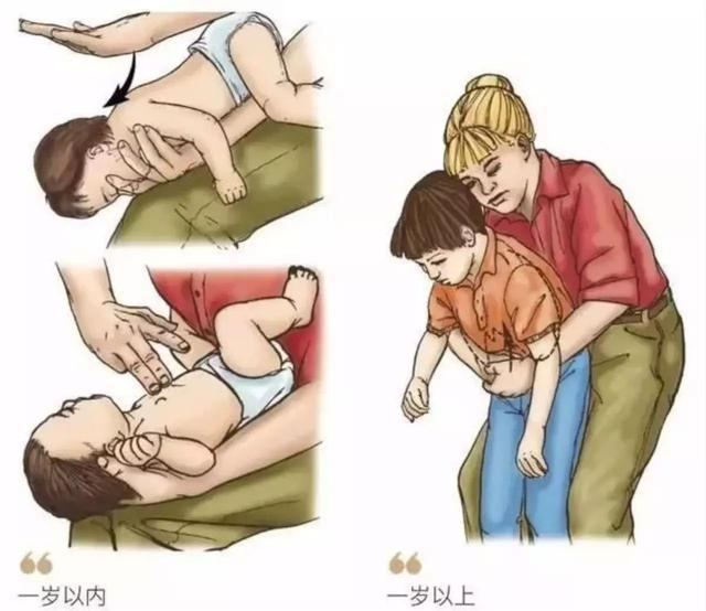 海姆立克|宝宝异物卡喉别拍背部!救人无数的海姆立克急救法一招搞定!