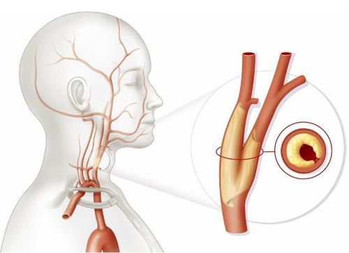 体积|男子查出颈动脉斑块，一年后复查，斑块变小了，看他是怎么做的？
