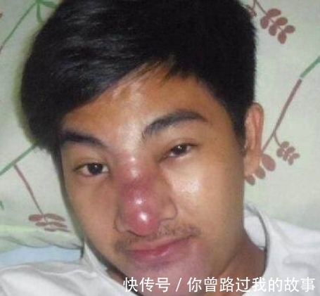 小伙|小伙花费70元整容,结果整容失败致脸部溃烂,帅小伙变成丑男