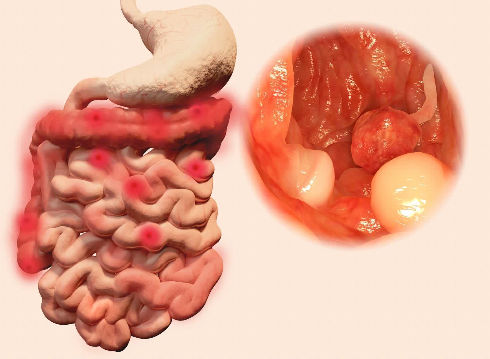 结肠癌|会癌变的肠息肉越来越多,1个习惯是凶手!医生奉劝赶快远离