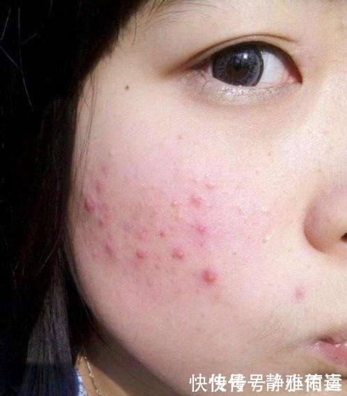 感染率|床上螨虫成窝教你一个土方子,让螨虫无所遁形