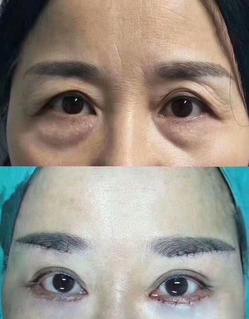 提眉手术给眼周带来多大变化，50岁姐姐来说说自己的“心路历程”