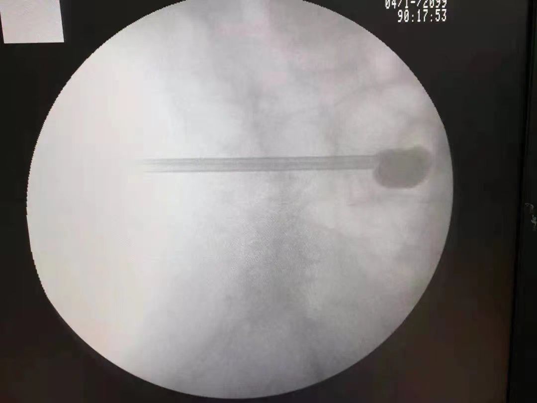 余杭|“感谢余杭来的骨科医生!” 援川医生在稻城成功实施首例脊柱微创手术