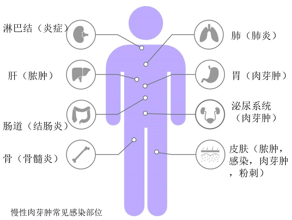 住院|4年反复住院12次、250余天！广西一男子确诊此罕见病，为全国首例成人发病